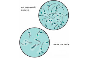 Что такое азооспермия - врач-уролог Нугманов Чингиз Аскарович