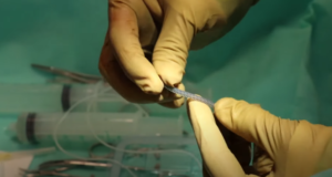 Видео: Операция «фаллопротезирование 3 компонетным имплантантом» (Ход операции, полное видео) - врач-уролог Нугманов Чингиз Аскарович